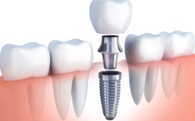 Totul despre implanturile dentare